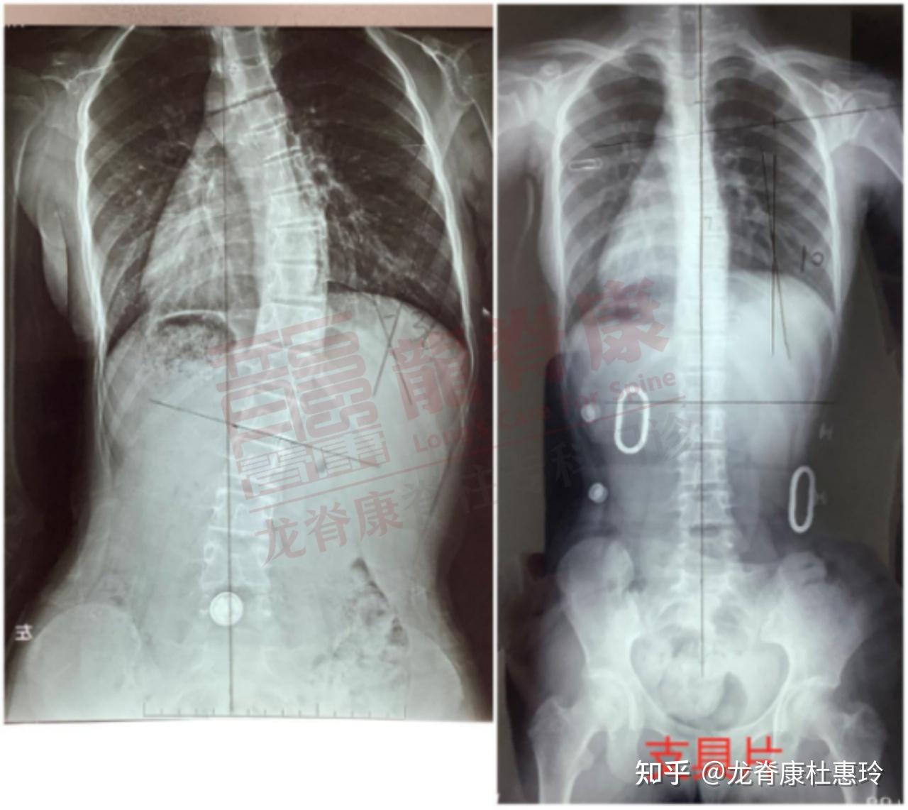 超过30度的脊柱侧弯,怎么改善? - 知乎