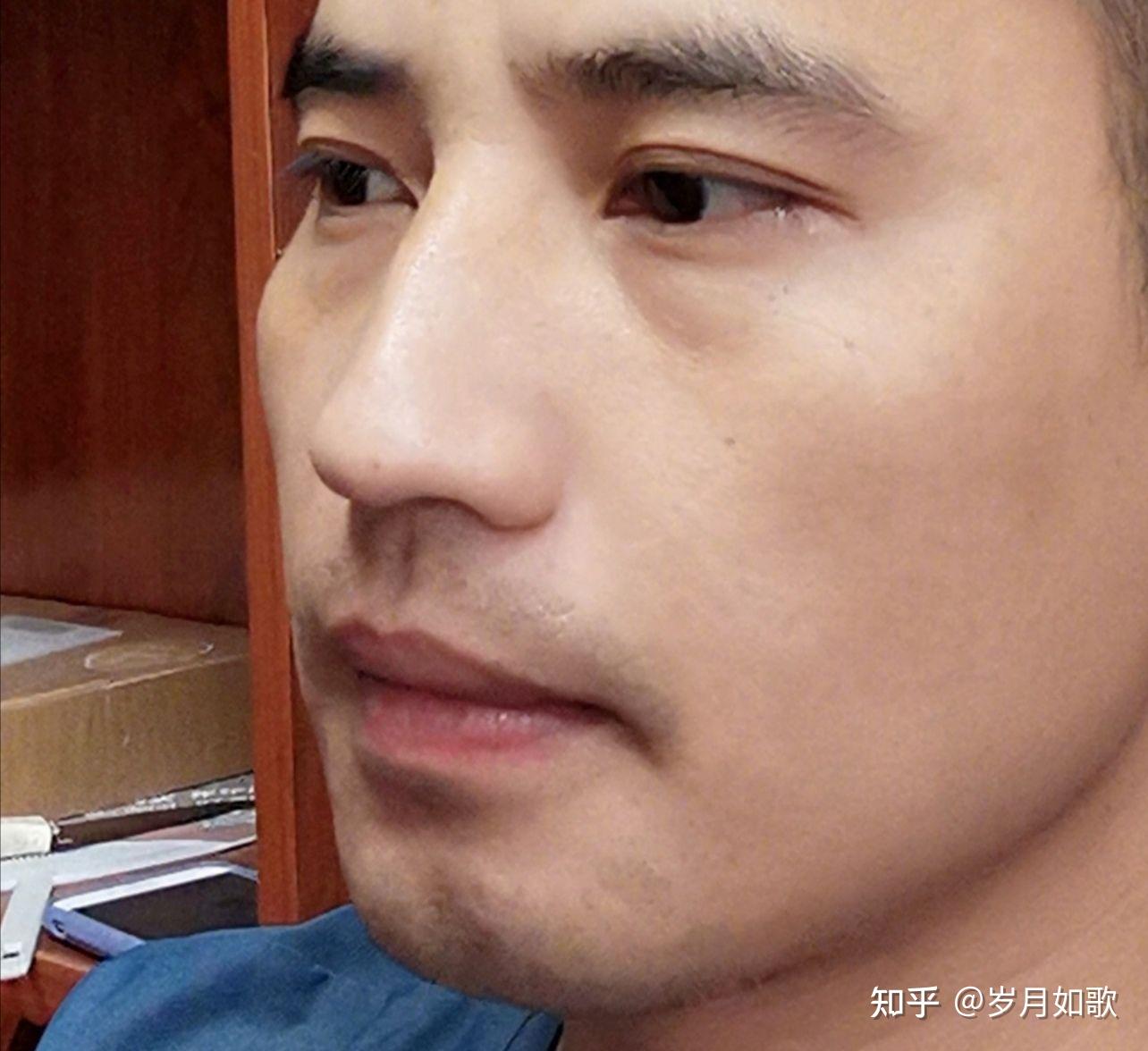 美人沟下巴(也叫苹果下巴,屁股下巴)很难看,怎么改善? - 知乎