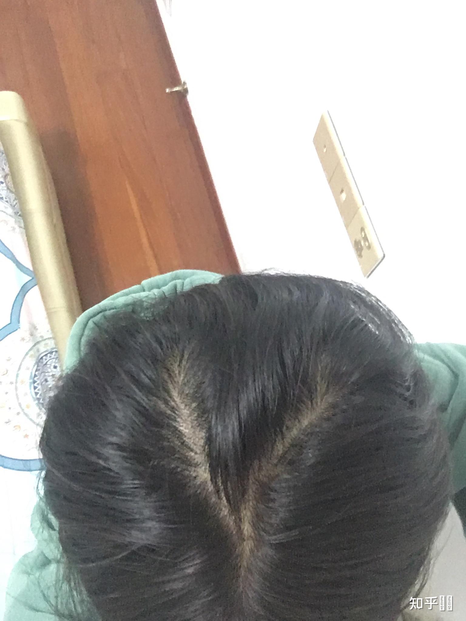 有头顶和我一样情况的吗?