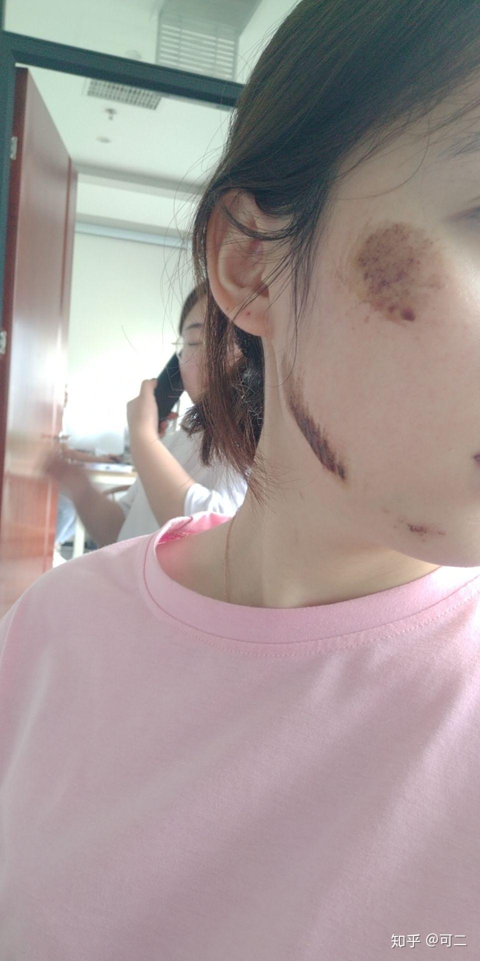 脸部擦伤如图,请问如何恢复? - 知乎