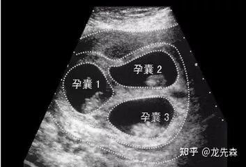 多胎妊娠是福还是祸?双胞胎?三胞胎?什么是多胎妊娠?有哪些风险? - 知乎