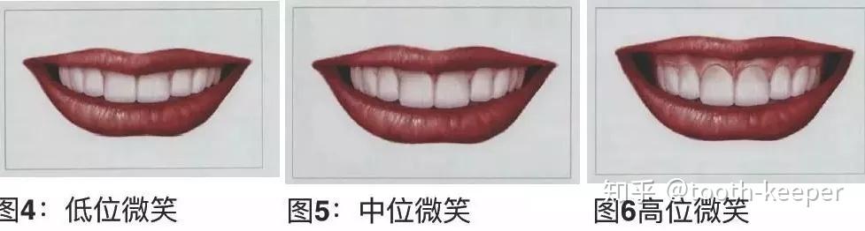 干货分享-笑线分型、分类与美学区种植风险及难度评估 - 知乎