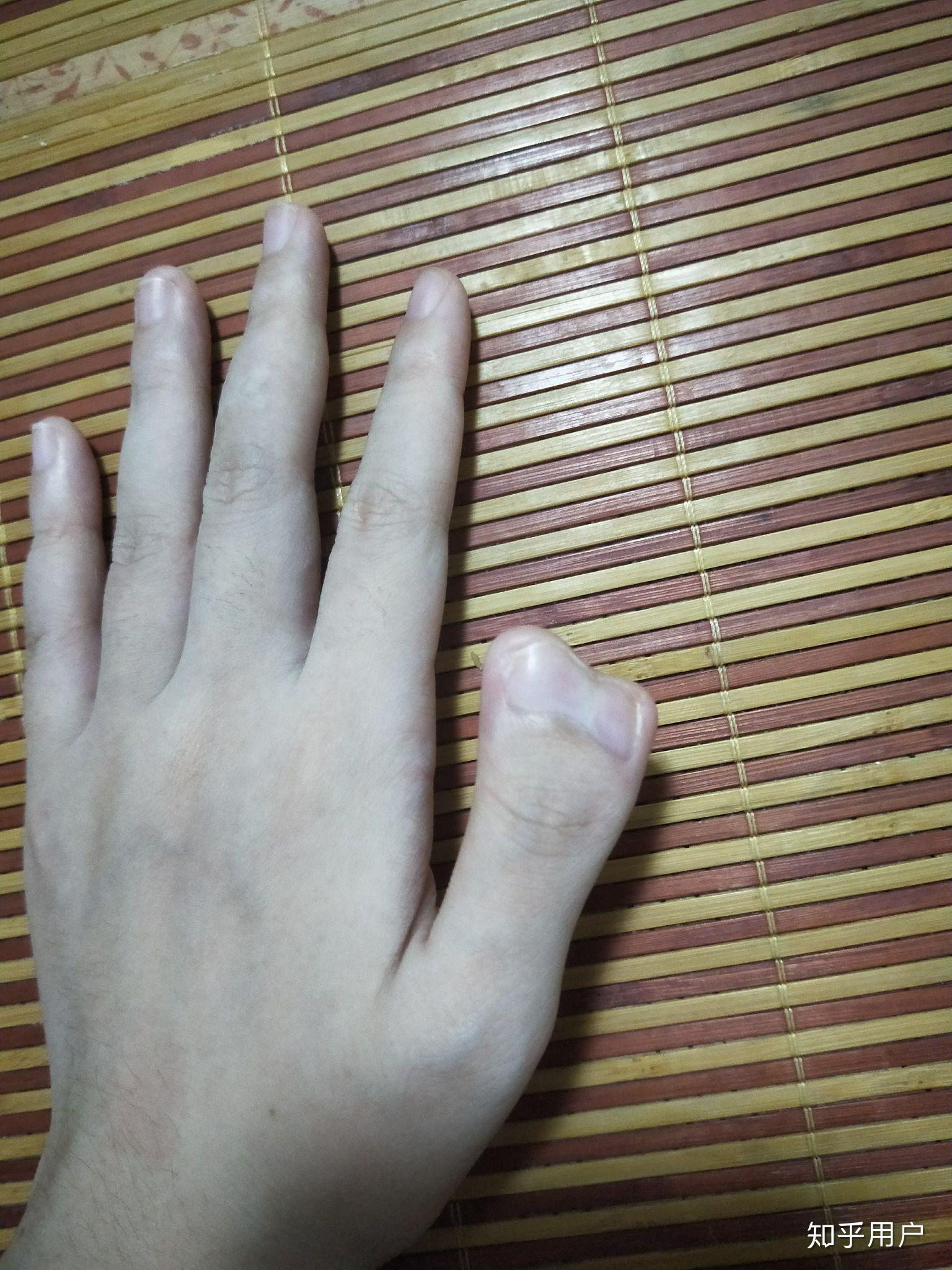 一只手有六个手指是种怎样的体验