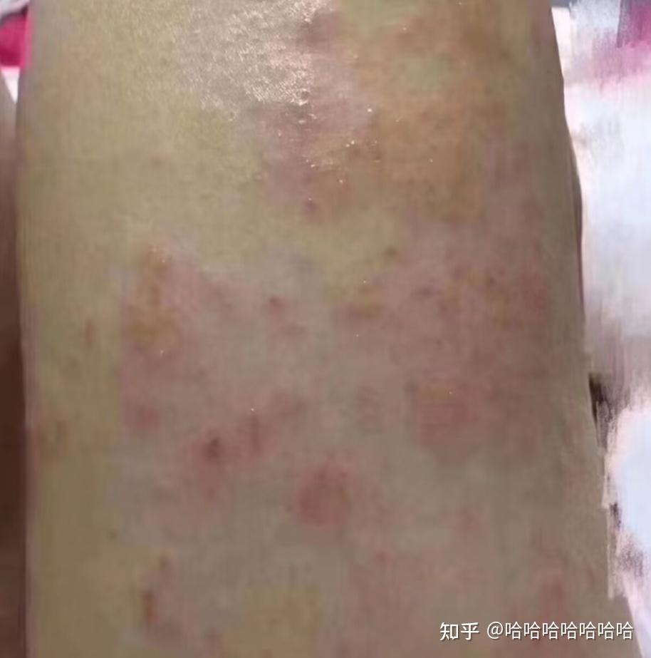 这玩意儿救了我的疹子,早知道早用了! - 知乎