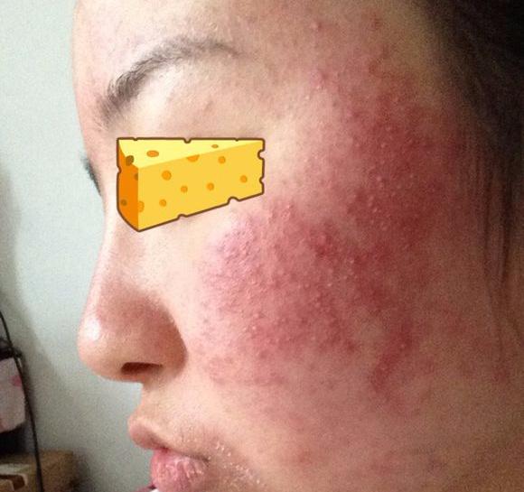 全脸脱毛后起鸡皮疙瘩痒(脱毛后皮肤痒起疙瘩怎么处理)