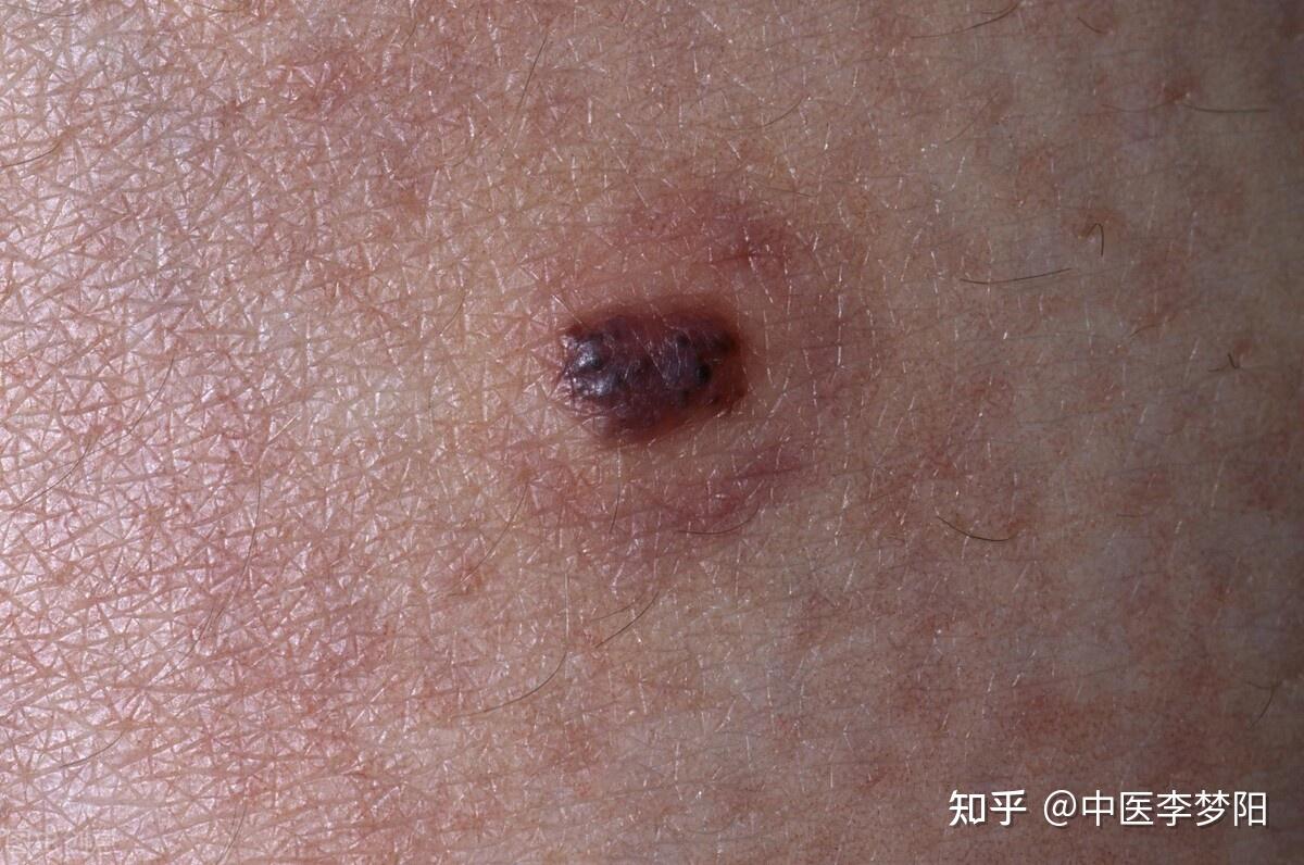 身上有了血痣,小心是肝胆病变的前兆!李医生教你如何应对 - 知乎