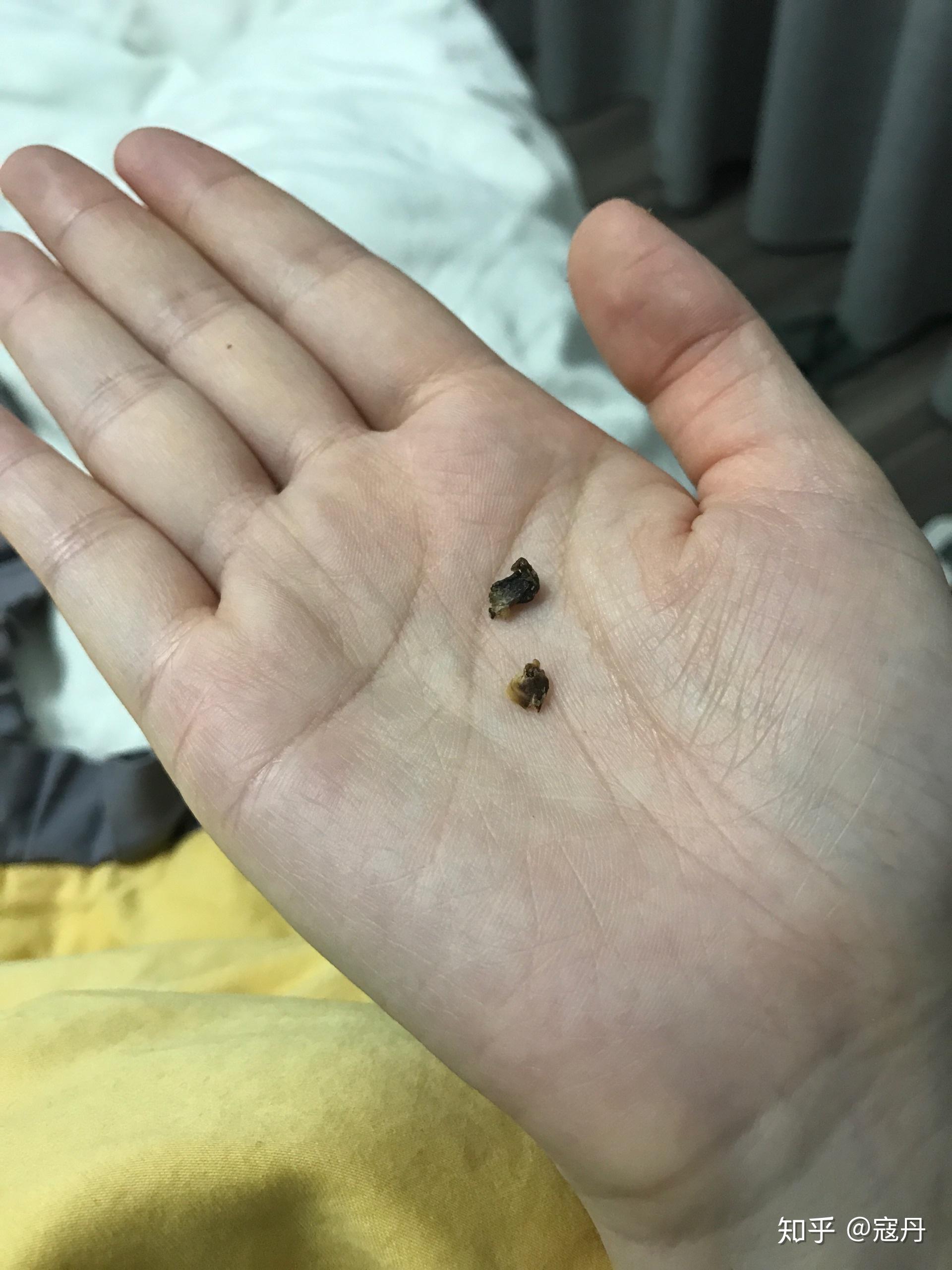 耳屎能大到什么程度