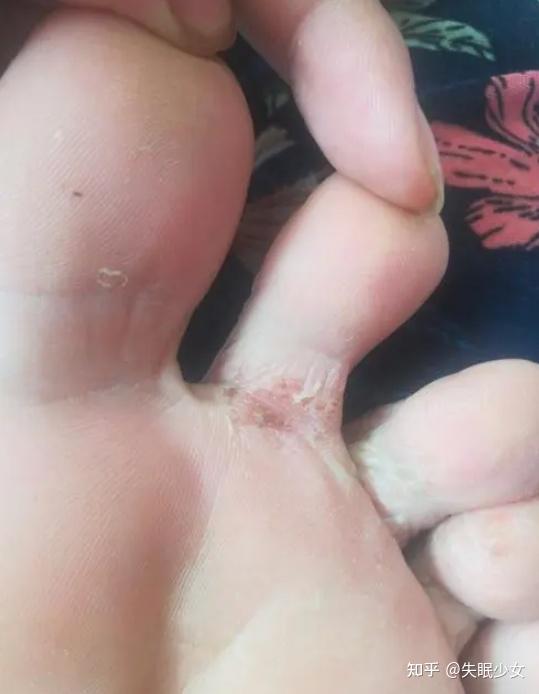 小姐姐脚部现在是什么状况?