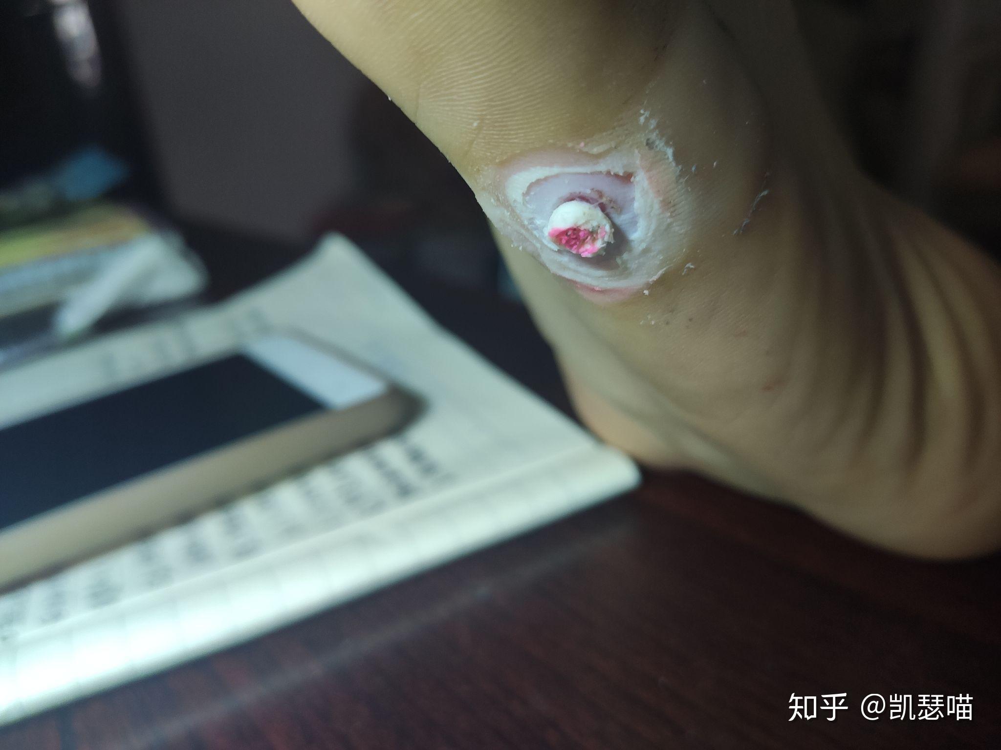 鸡眼怎么彻底挖出?