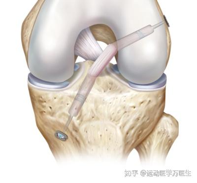 叉友们请注意!全世界前交叉韧带大佬们齐聚一堂,竟然得出了这些的结论! - 知乎