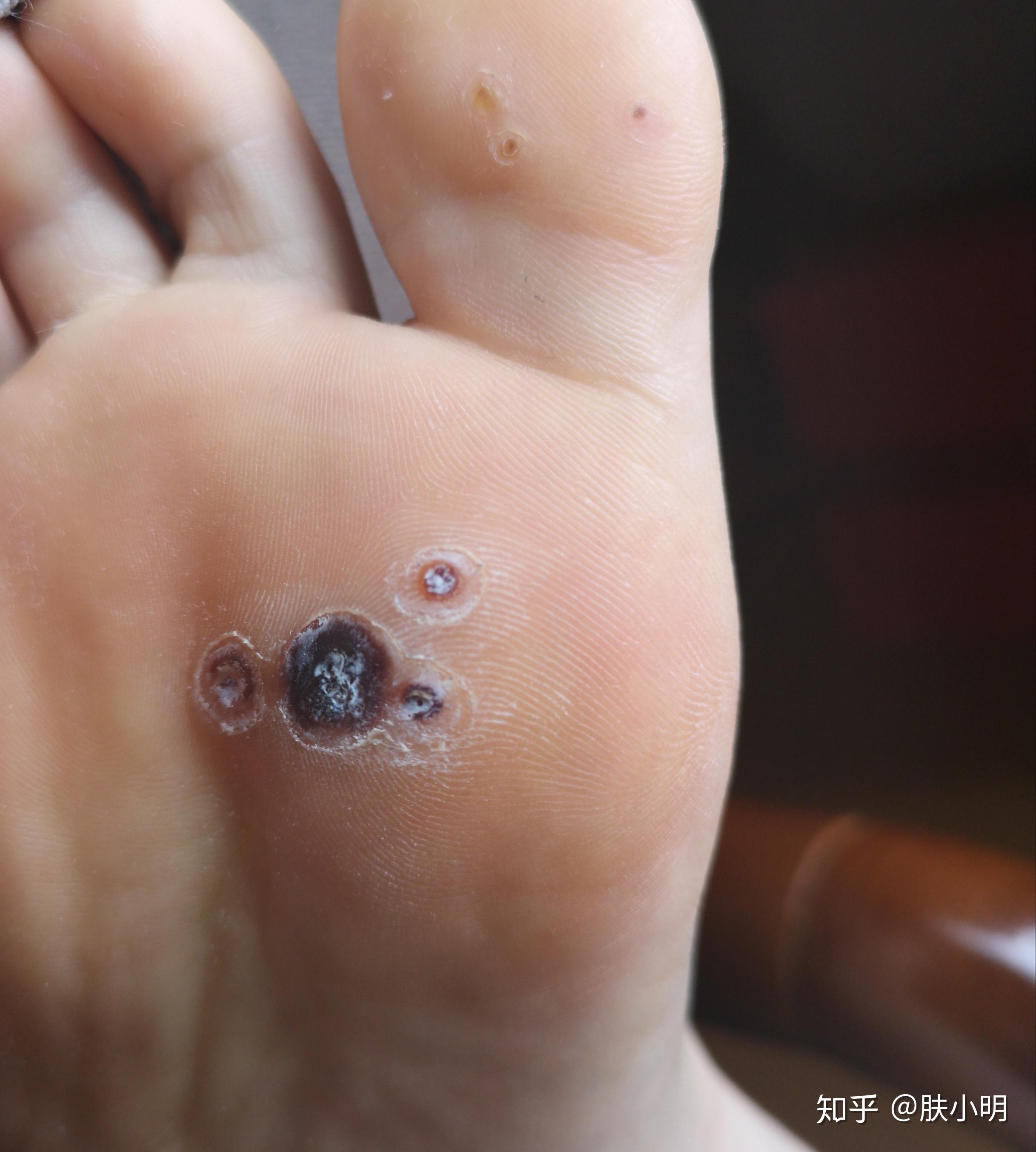 脚底长了两颗跖疣,去药房问了,医生给了瓶除疣液和贴布上面写适用鸡眼