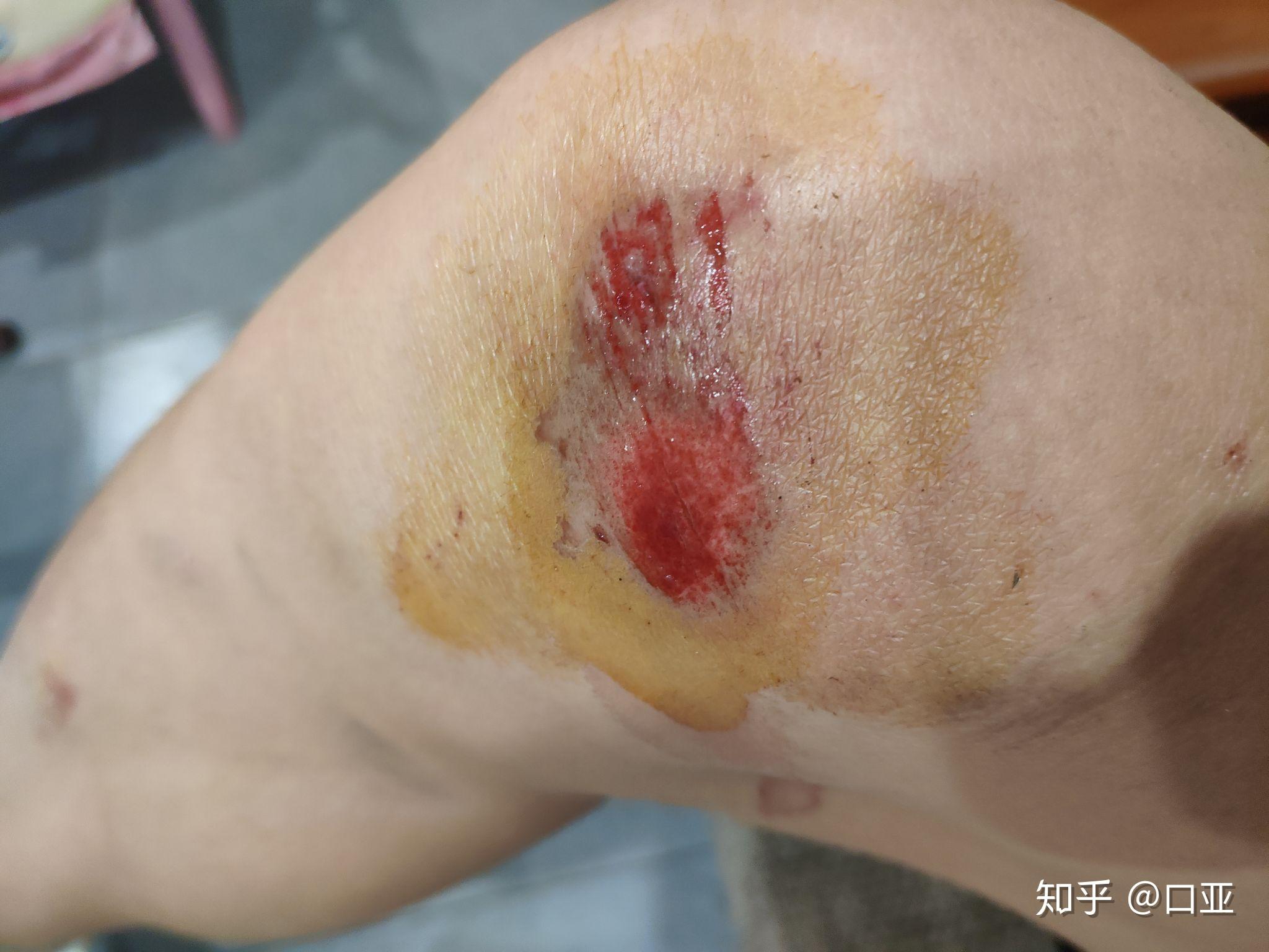 比如说摔了一跤,膝盖破了一平方厘米,这时用双氧水消毒的痛感是几级?