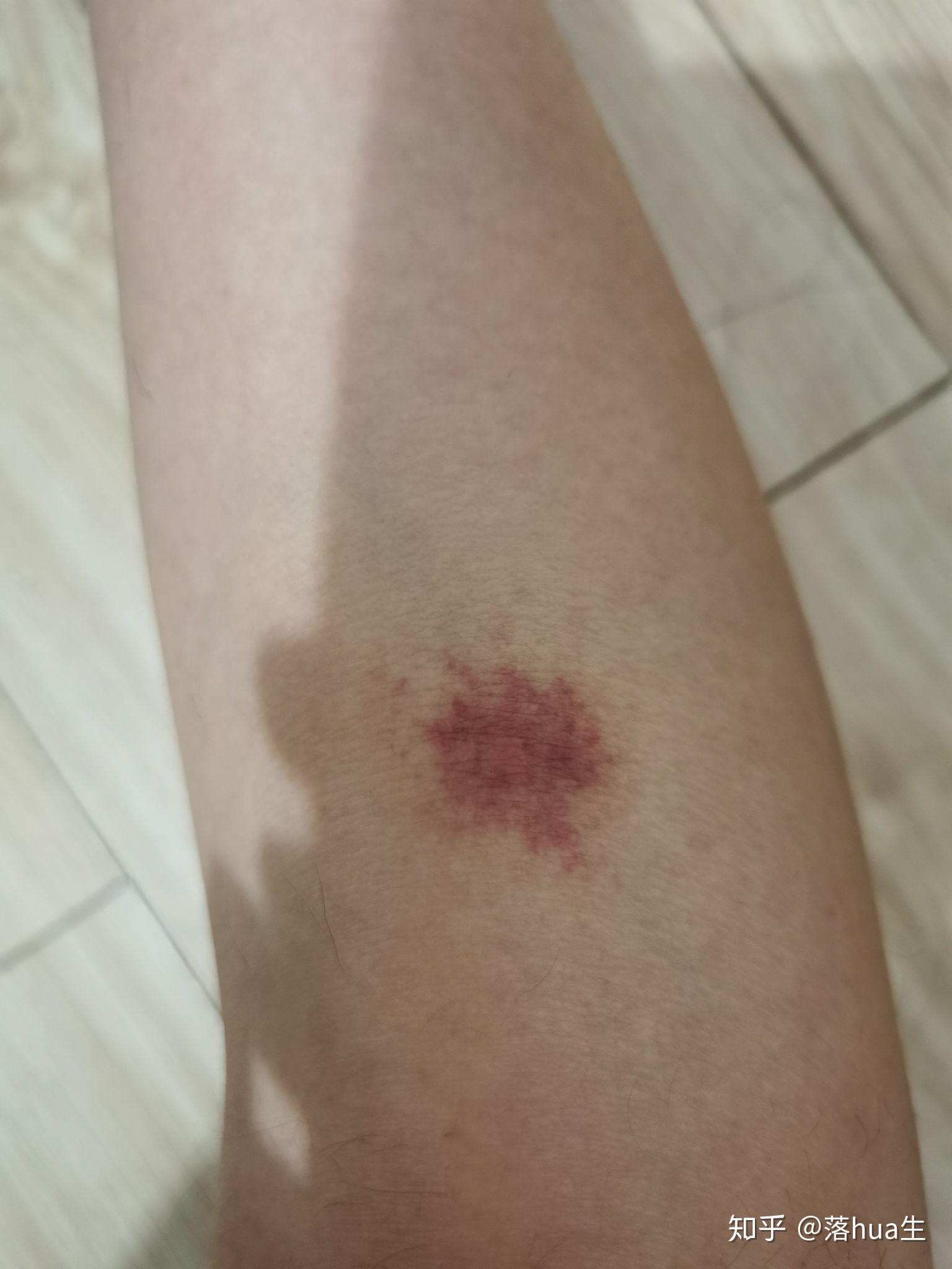 为什么我被蚊子咬了之后皮肤会变成类似淤青的紫红色消退的很慢肿的