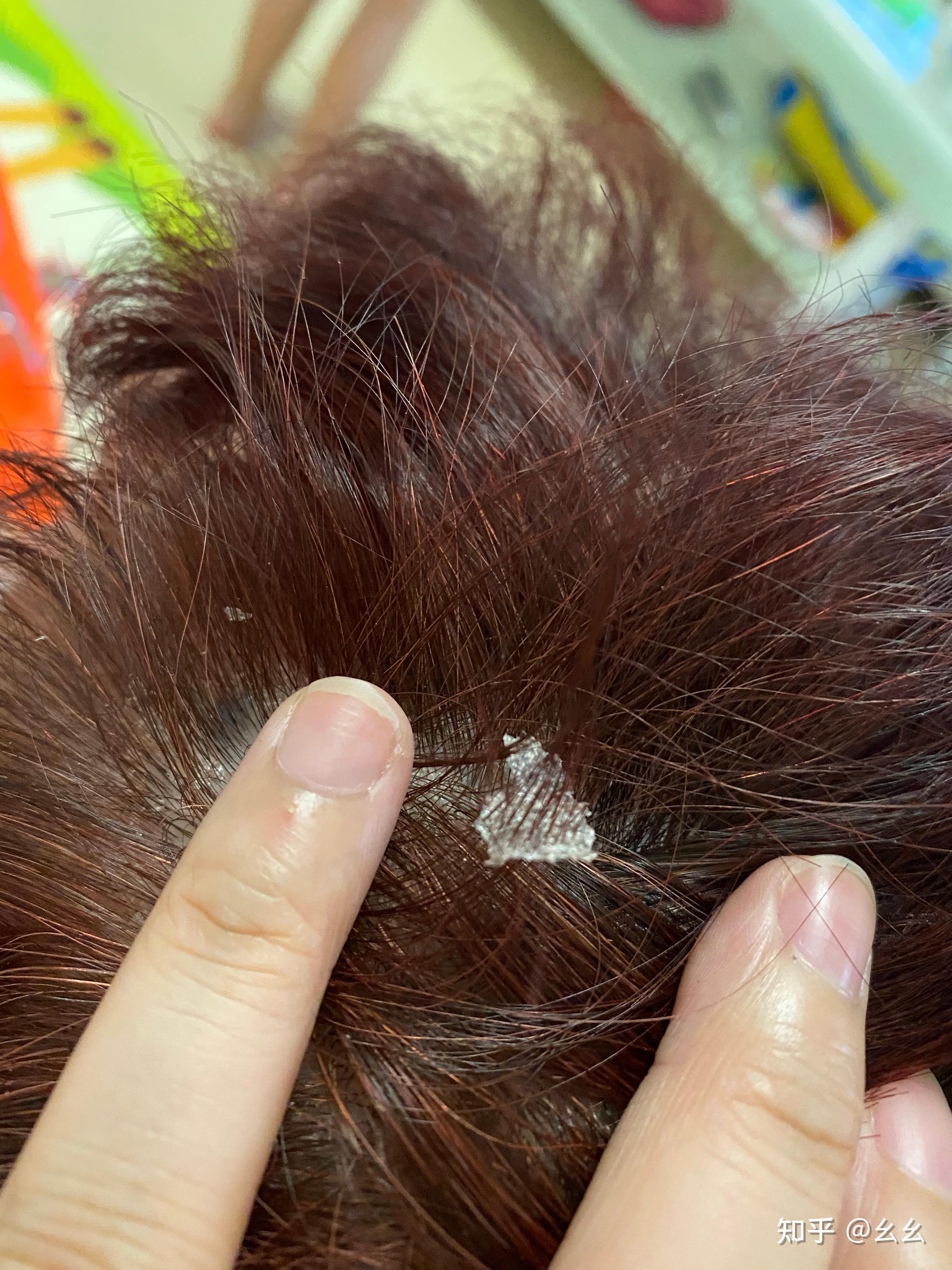 见过的最大头皮屑多大