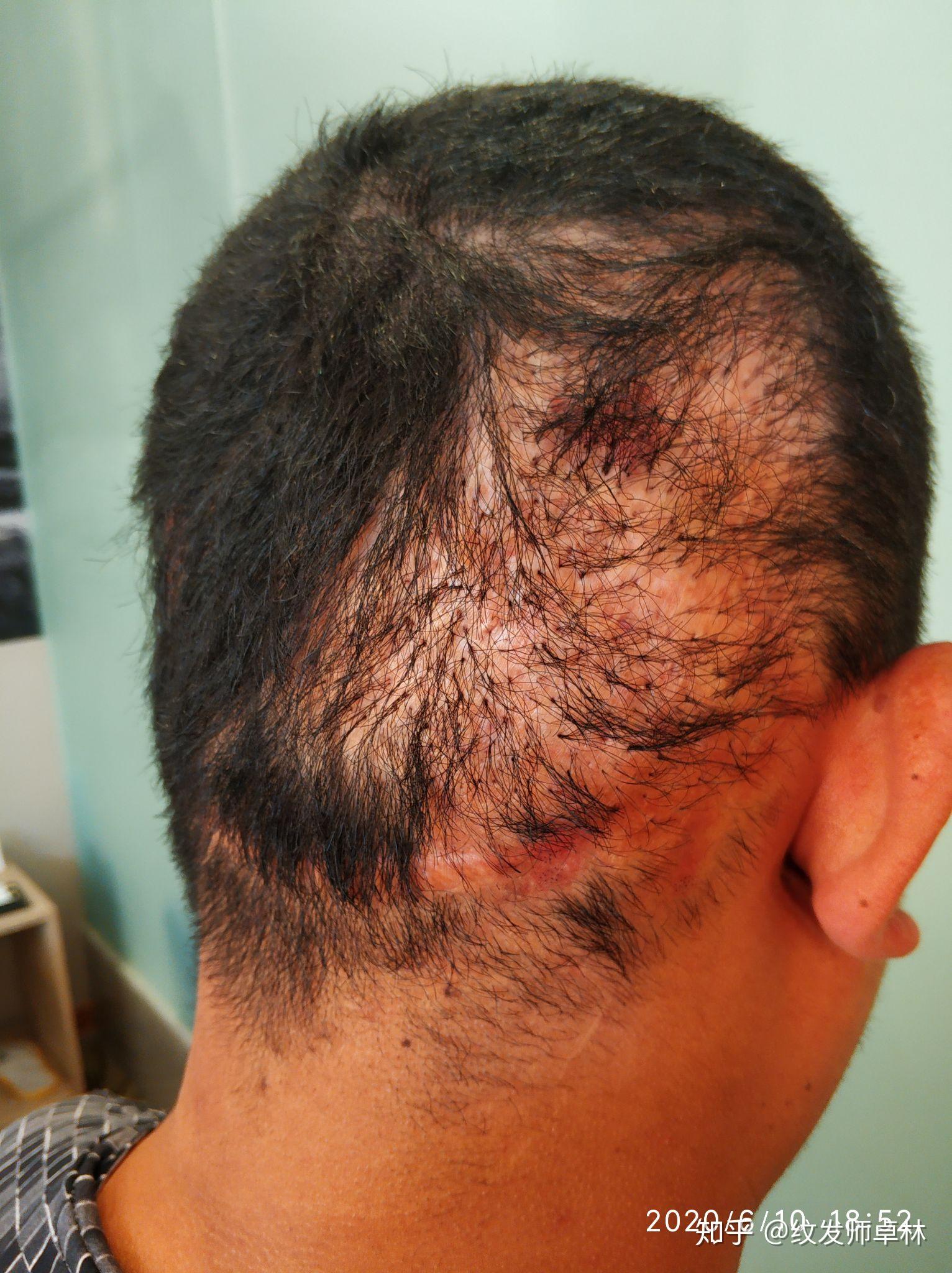 头皮上有手术疤痕十几年来都束着头发要工作影响形象有没有办法祛疤