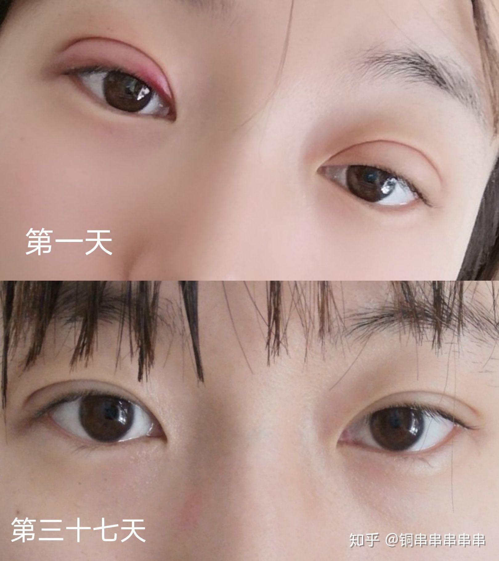 记录自己的埋线双眼皮恢复过程