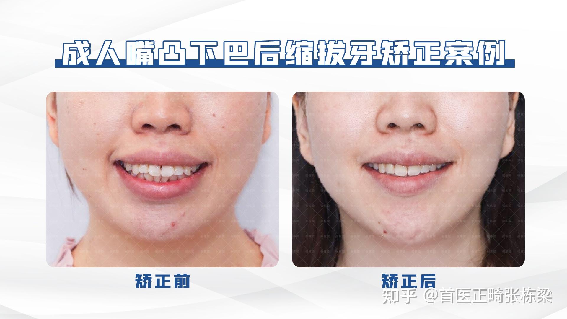 如何分辨下颌后缩和下巴短？