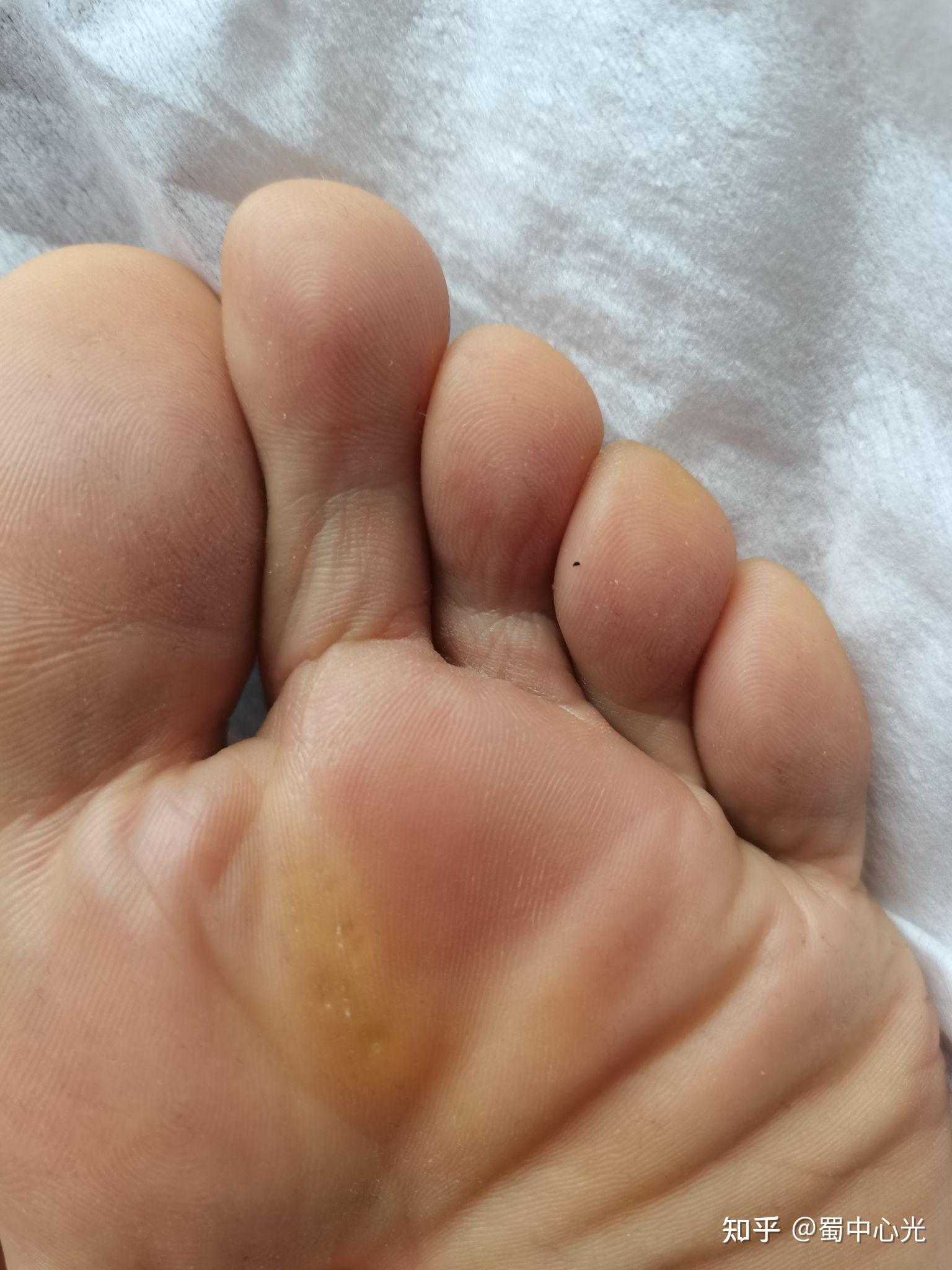 为什么徒步脚会起水泡?