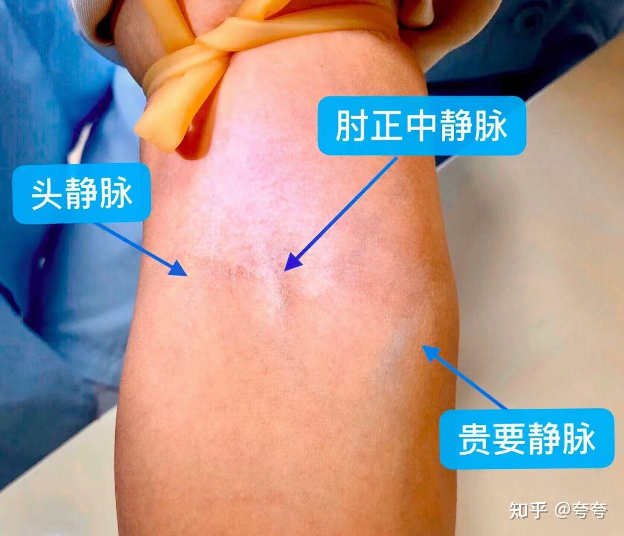 人的肘部,大概有多少根血管,可以用于 抽血?