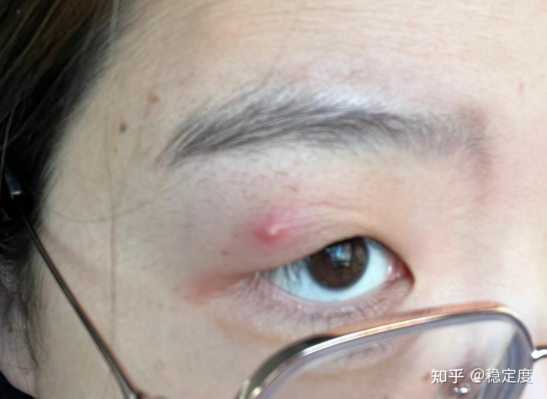 眼皮上起了一个粉刺是什么感受