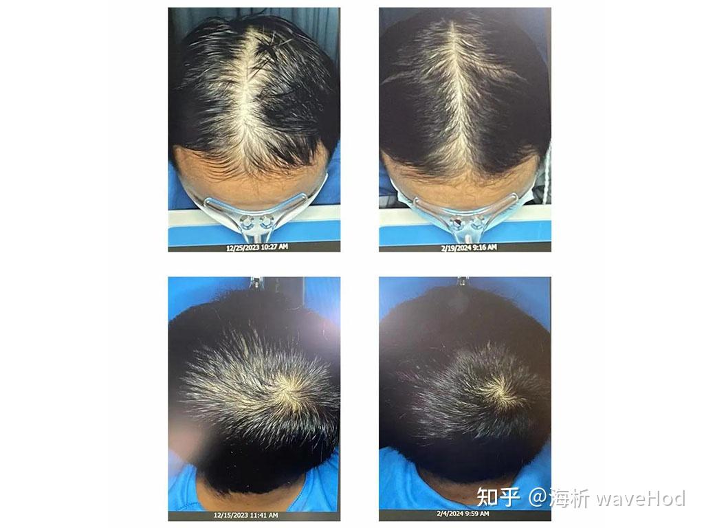 HMI-115 二期临床试验生发对比图泄露 - 知乎
