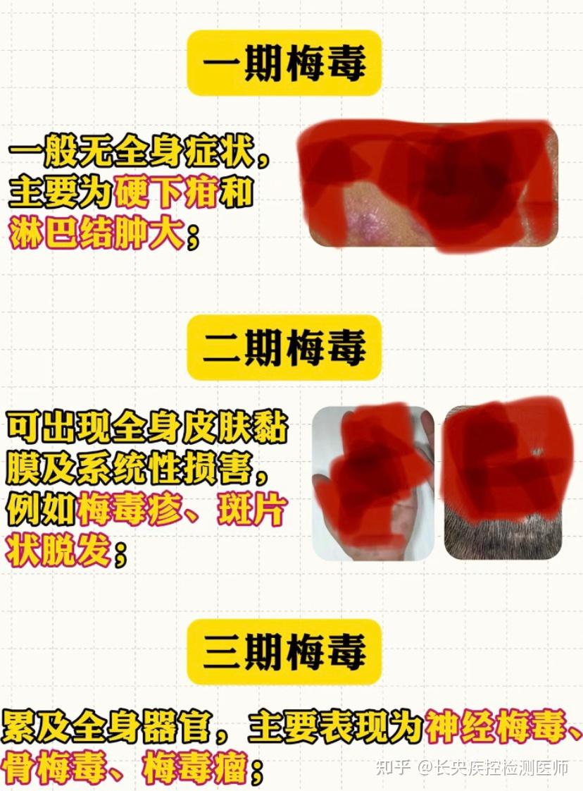 这是梅毒硬下疳早期吗?