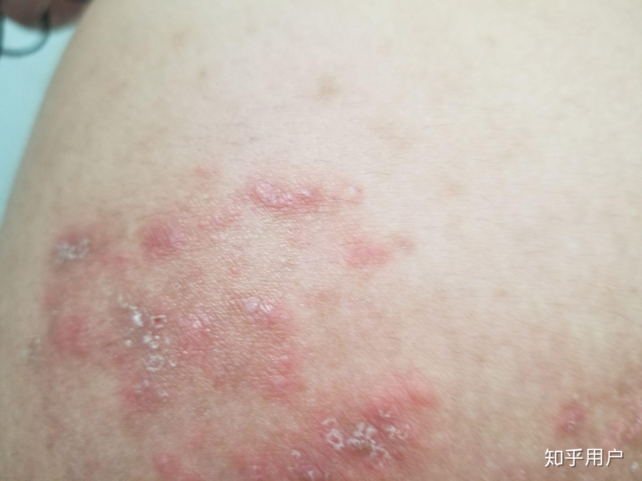 请问这是湿疹还是股藓有图慎入