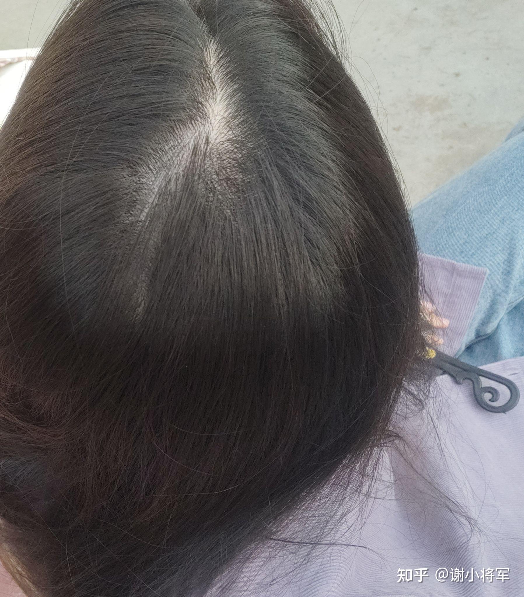 女生秃顶是怎样一种体验