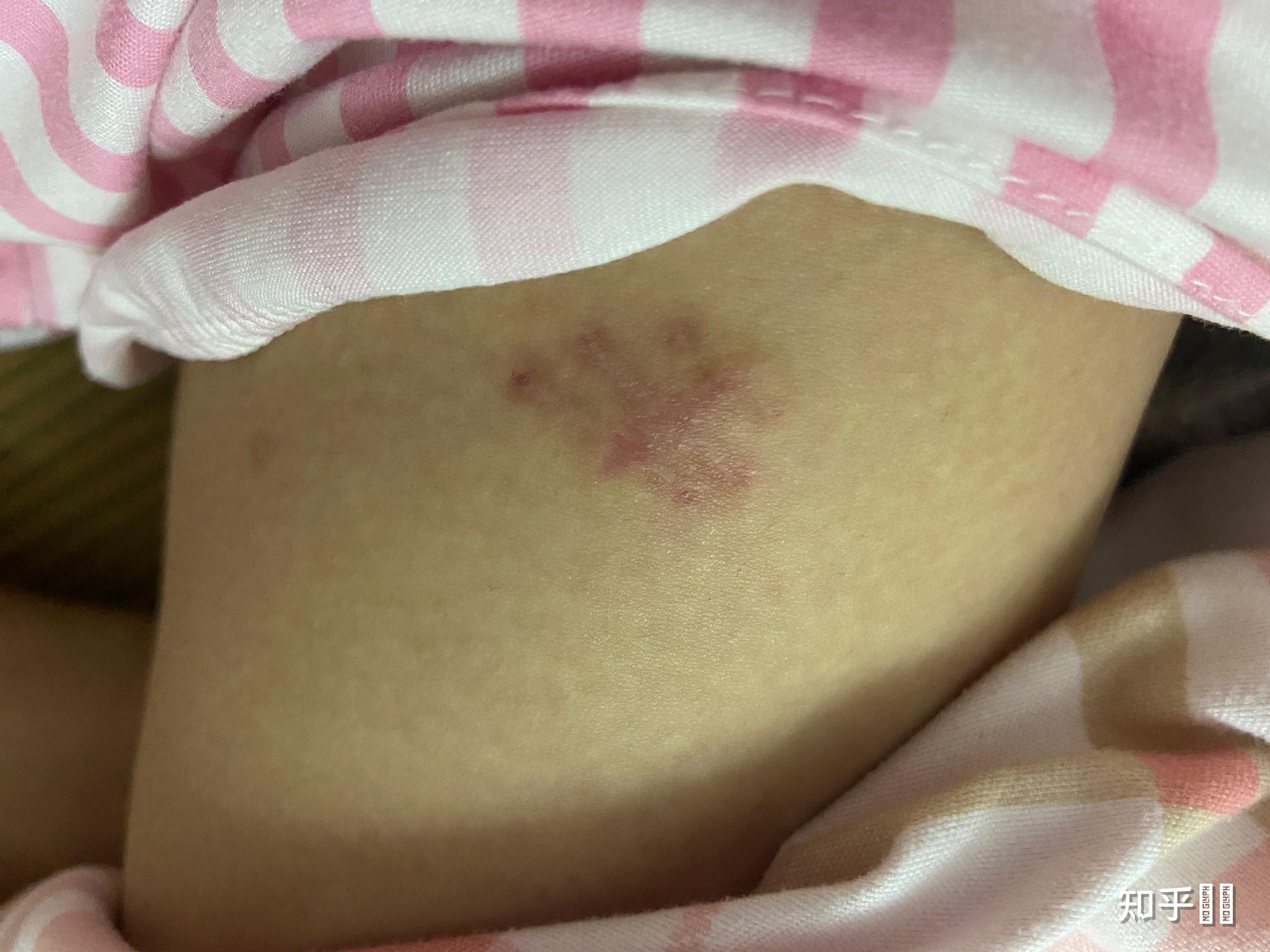 脂肪瘤手术的感觉亲身体验