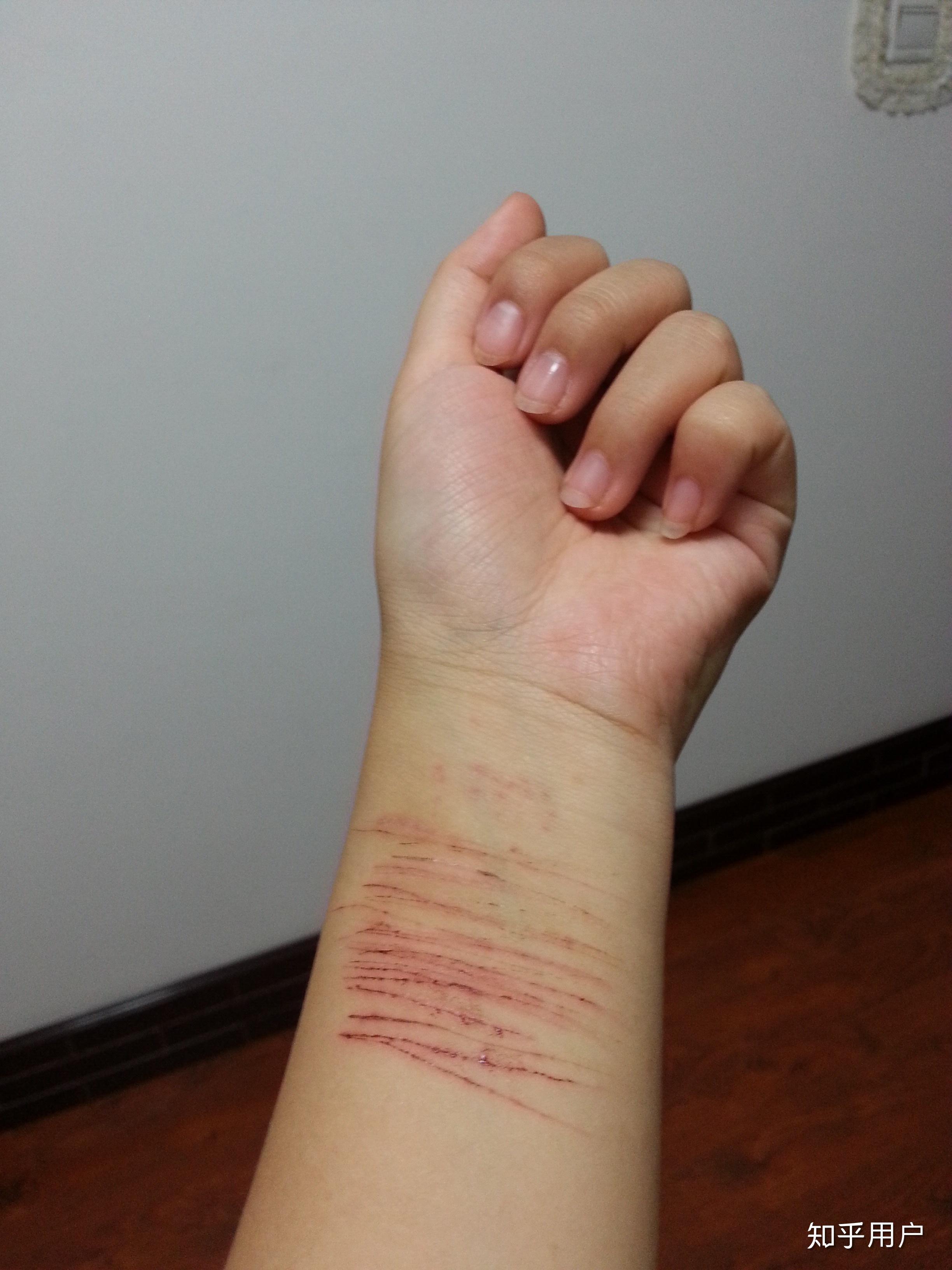 帮忙看一下这张割腕后的图会不会有什么后遗症