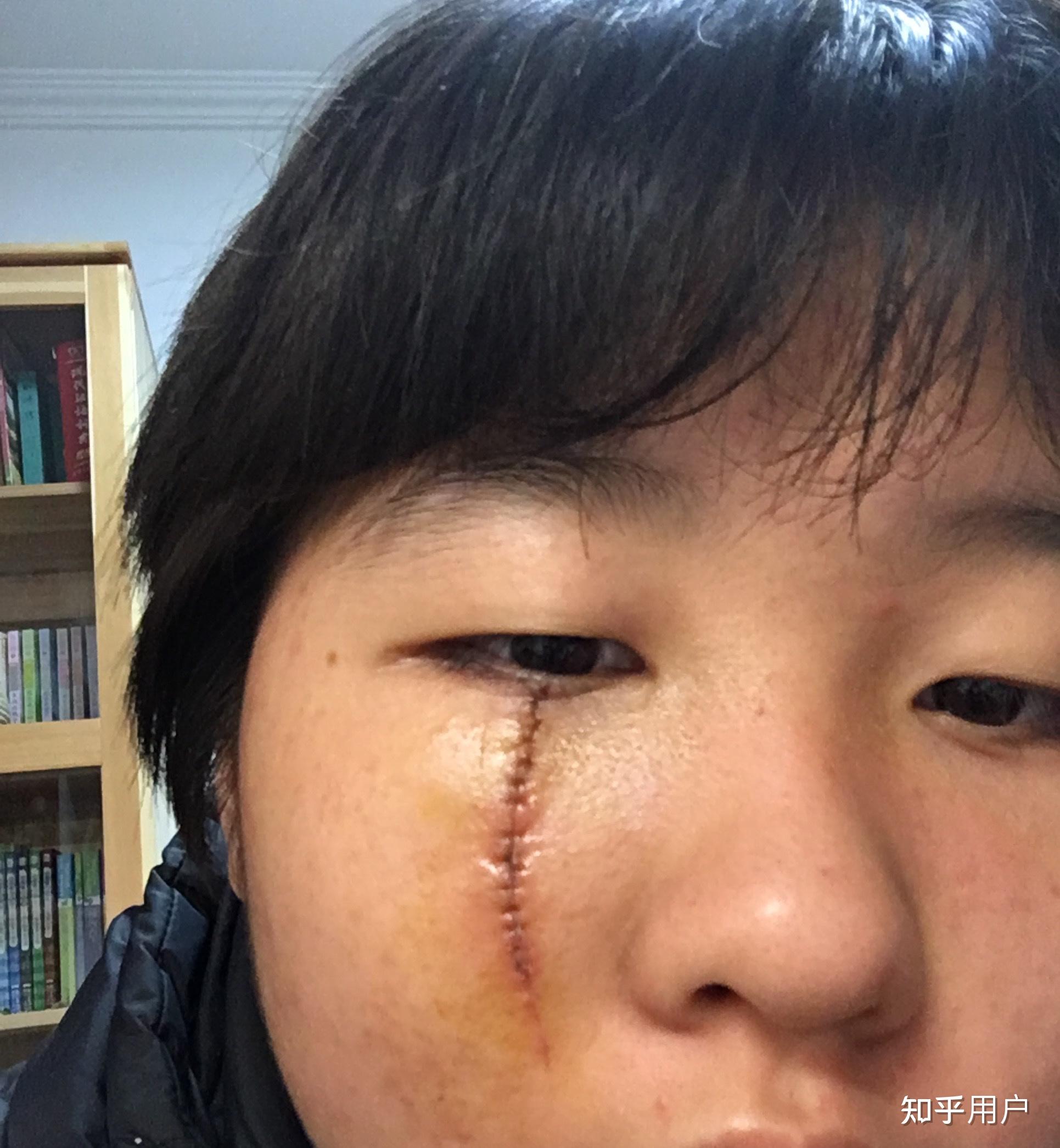 女生脸上有疤是怎样的体验? - 知乎