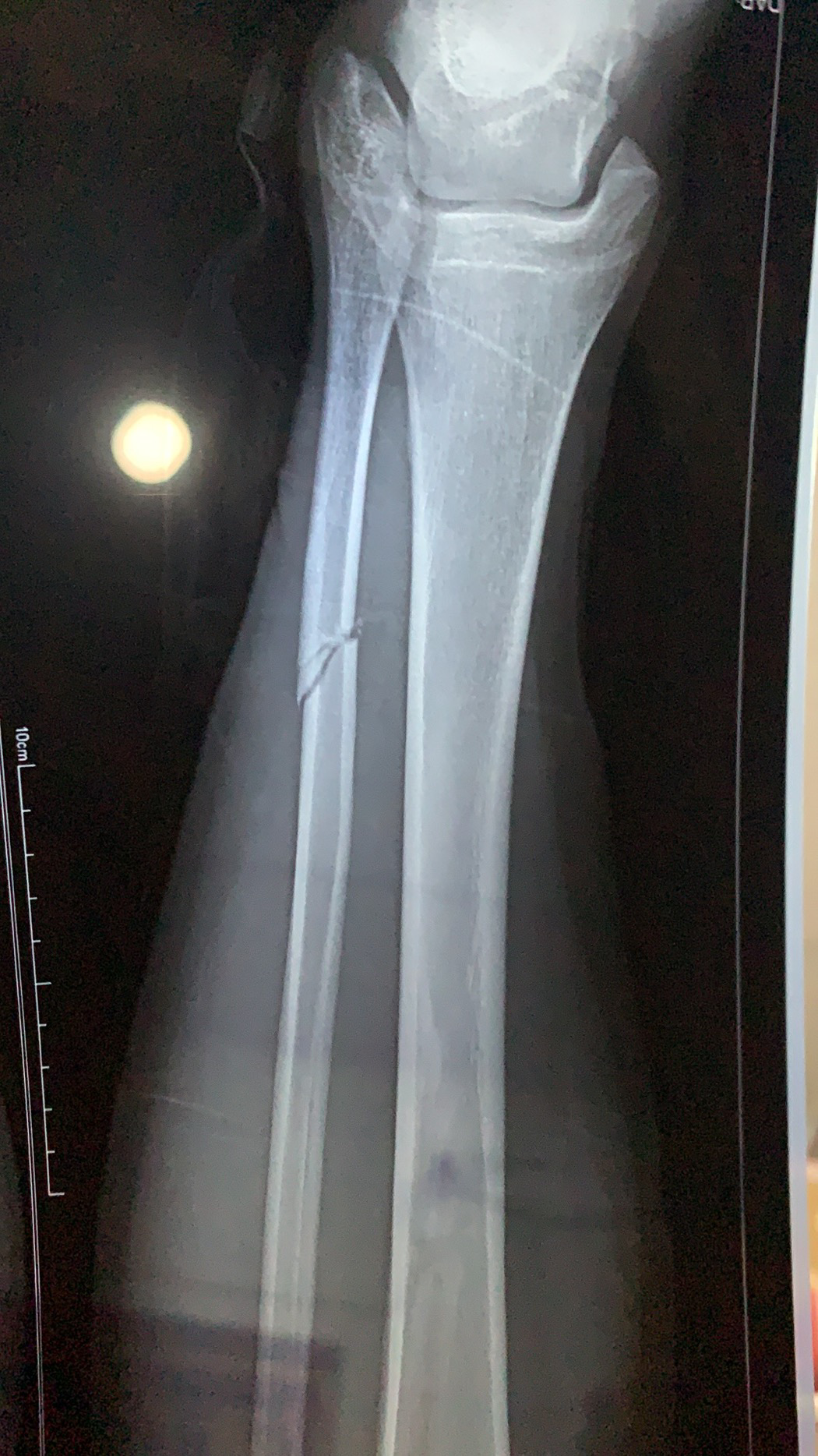 记录一下小腿骨折