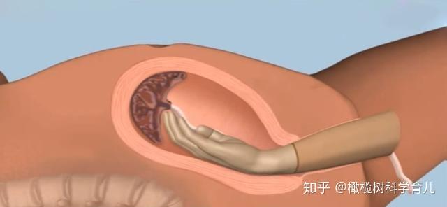 产后有胎盘残留怎么办? - 知乎