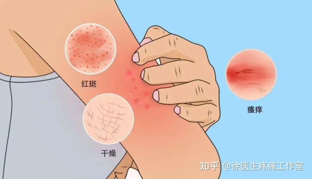 冬季痒越抓越痒是怎么回事!徐医生教你3招冬季痒,好得快 - 知乎