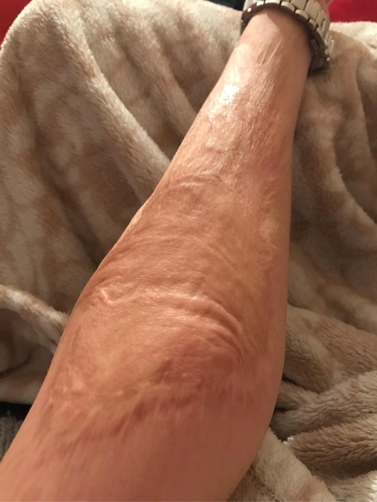 人们看到一个腿上有烫伤疤痕的女孩会怎么想呢? - 知乎