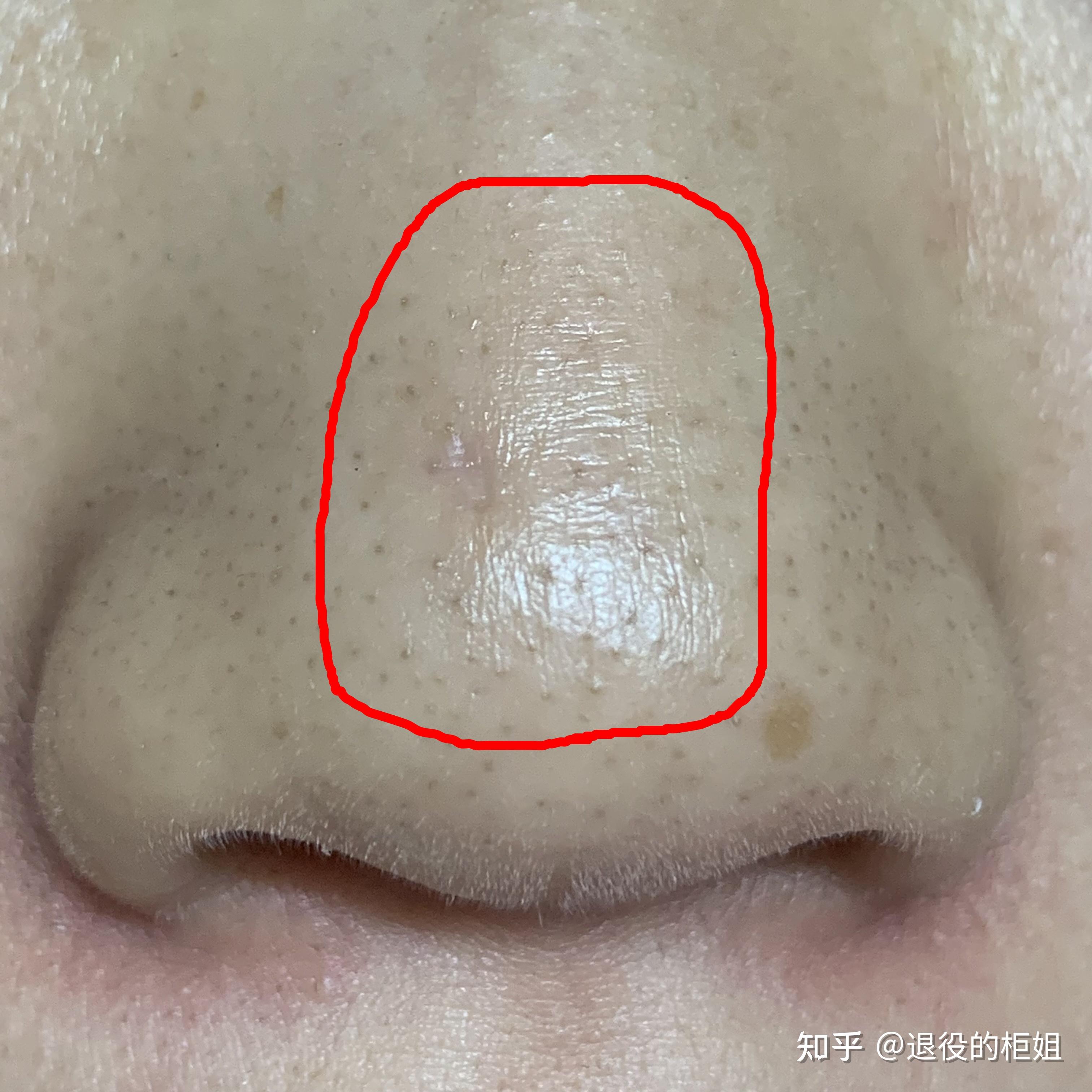 鼻翼疤痕修复+鼻槛中部缺损修复-杨杰-爱问医生