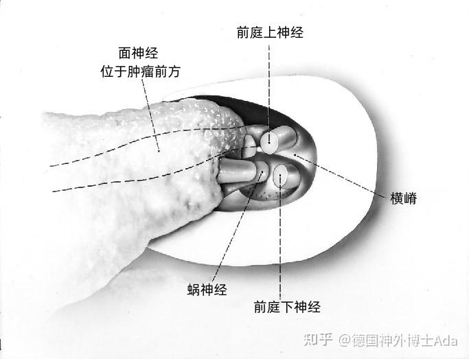 听神经瘤解剖---Rhoton解剖文献学习笔记系列 - 知乎