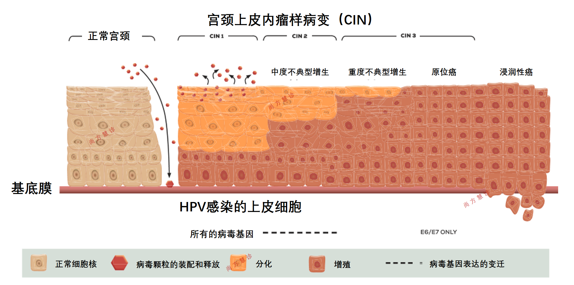 宫颈癌的演变过程图片图片