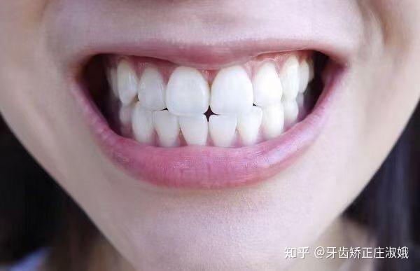 放松状态下上下牙齿是分开的还是咬在一起的