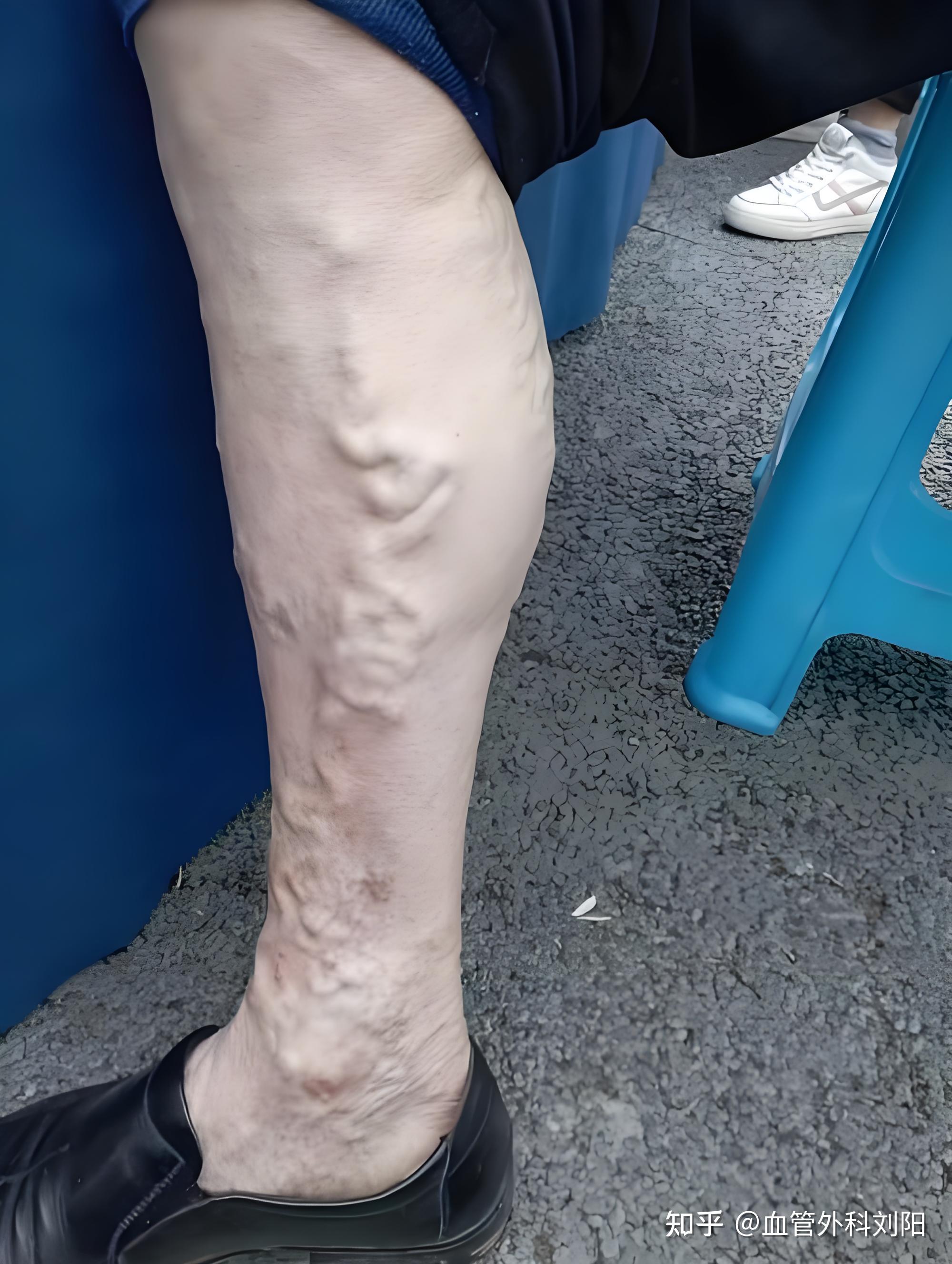 静脉曲张能不能治愈?