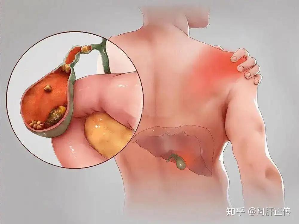 保胆取石是微创手术吗?具体有哪些术式? - 知乎
