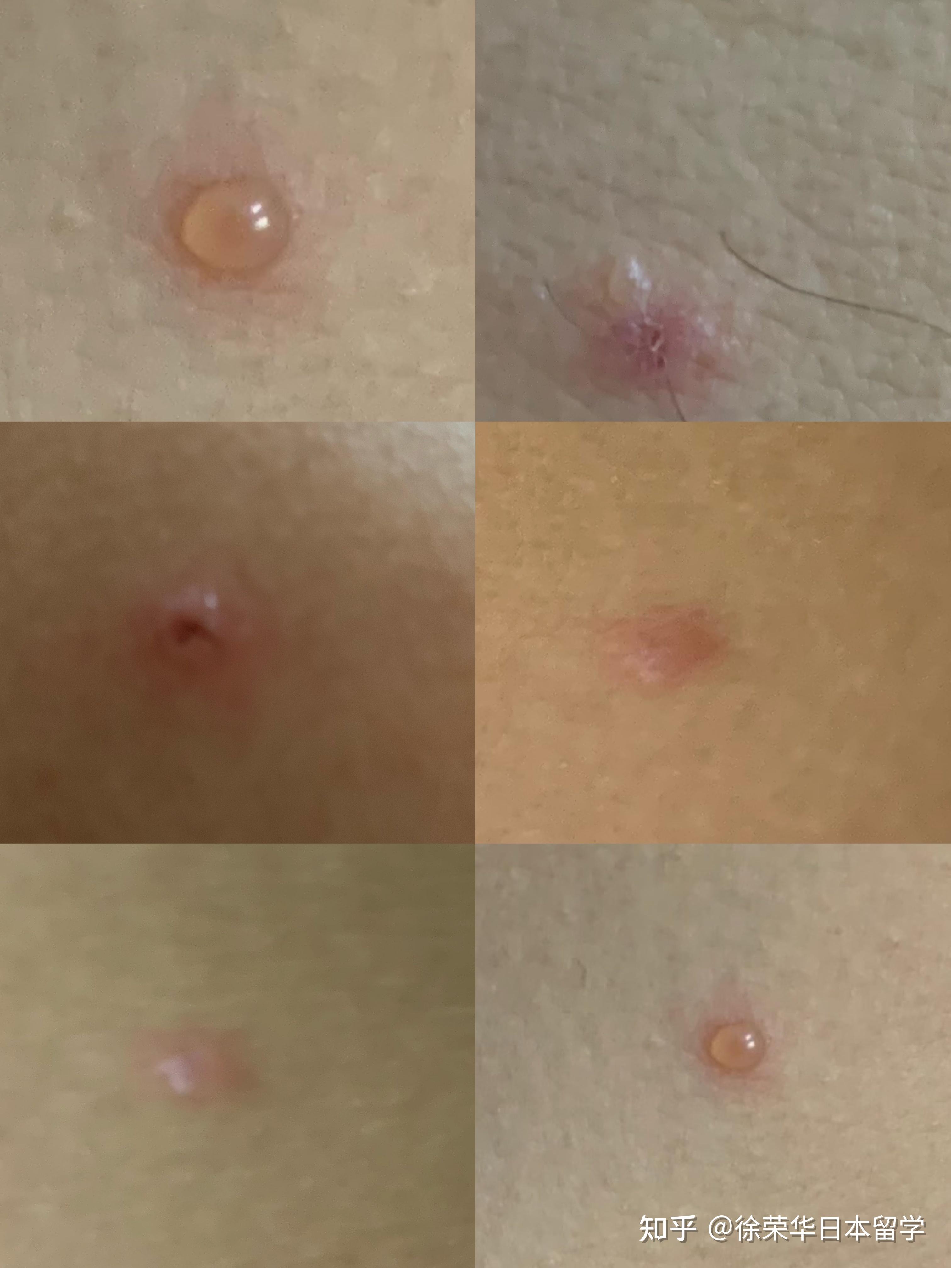 成人长水痘是什么样的经历