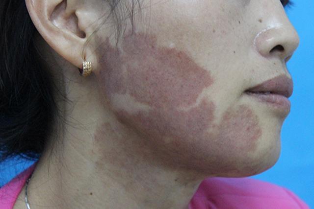 鲜红斑痣竟然会发展成这样!