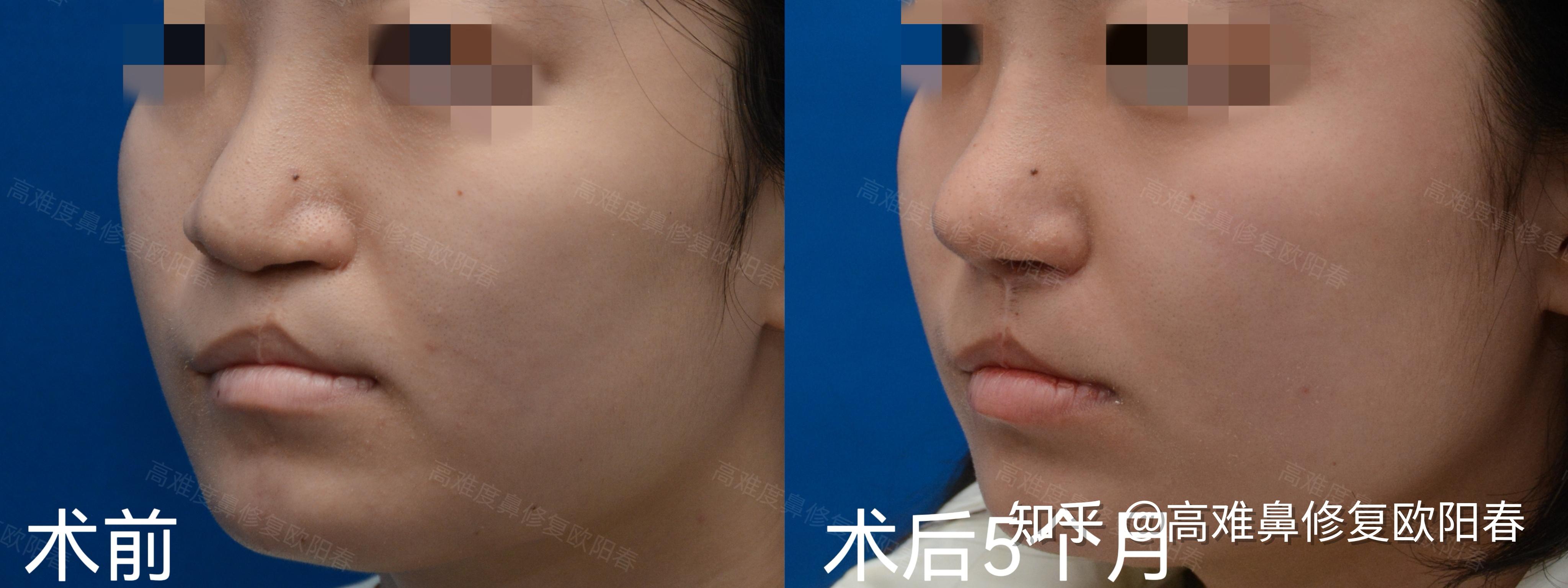 唇裂鼻畸形修复与美容鼻整形完美融合