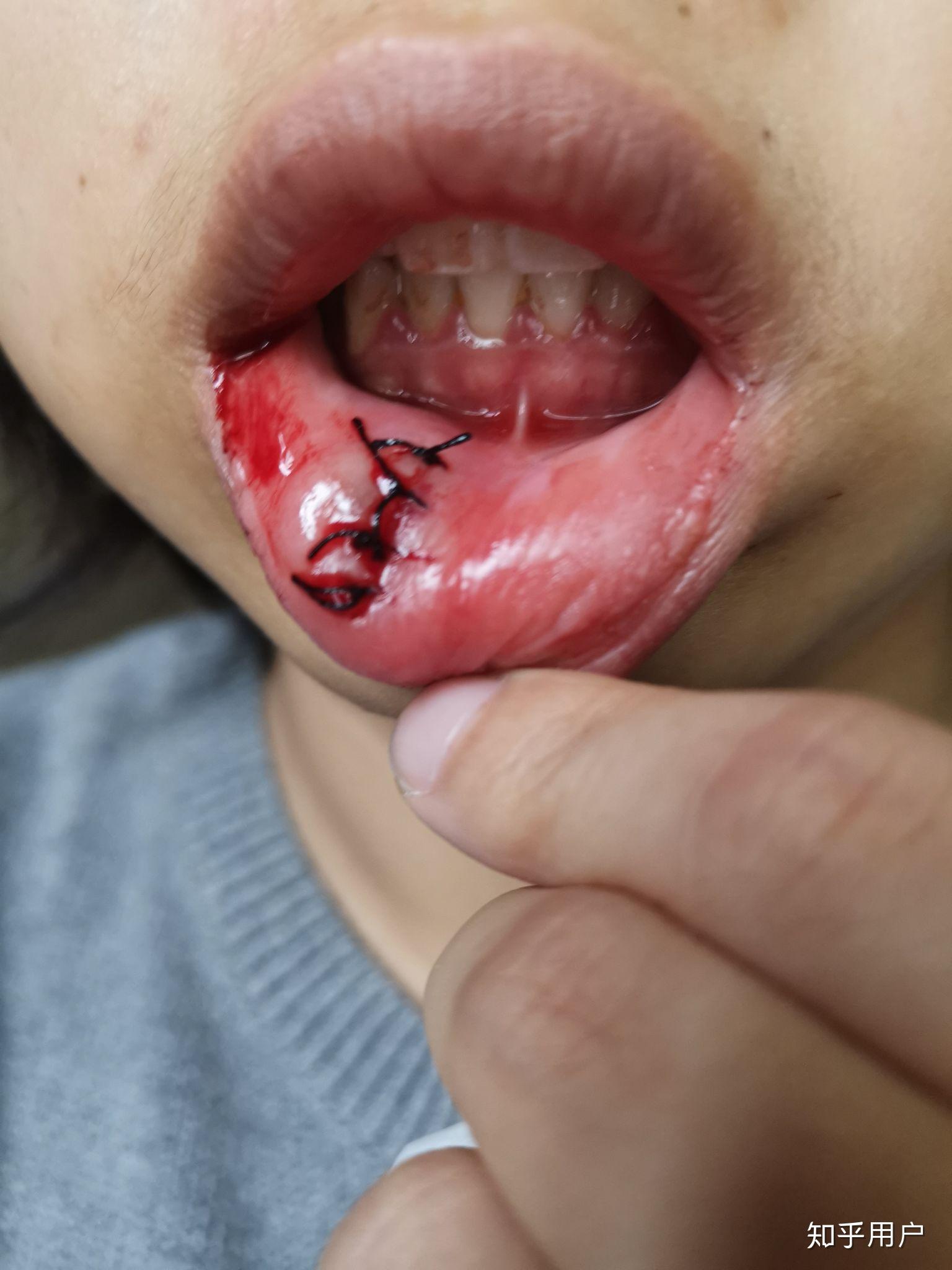 嘴唇粘液腺囊肿手术后?
