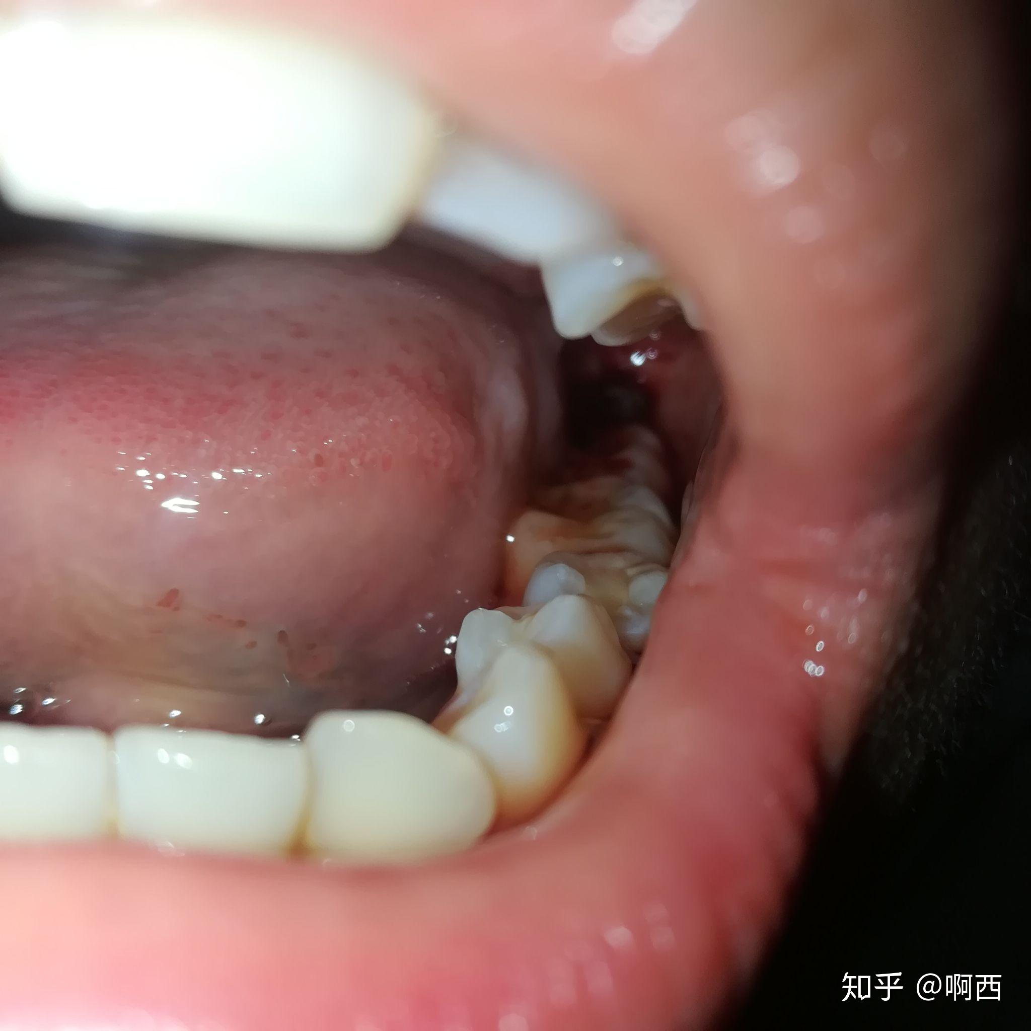 长了四颗阻生智齿是什么样的体验