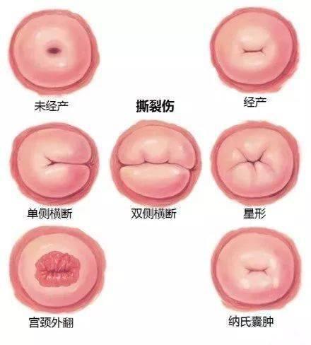 生过孩子的宫颈口和没生过的区别是什么