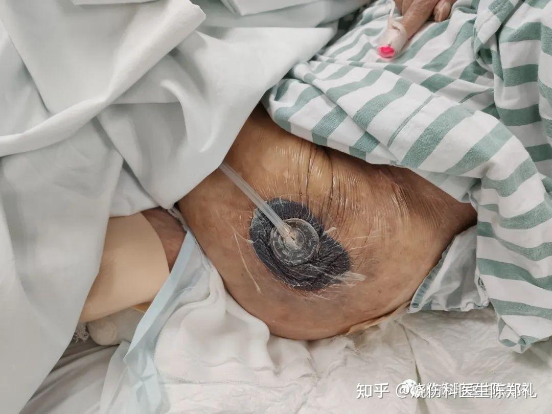 现在基本失去行走能力大小便失禁躺在床上现在又有褥疮的问题怎么办啊