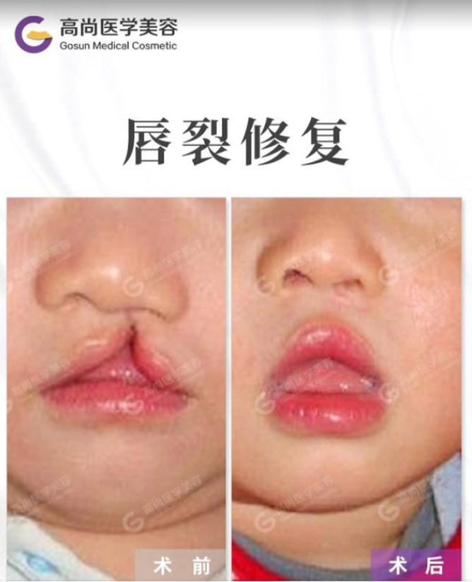 兔唇医院,兔唇手术前后对比照片