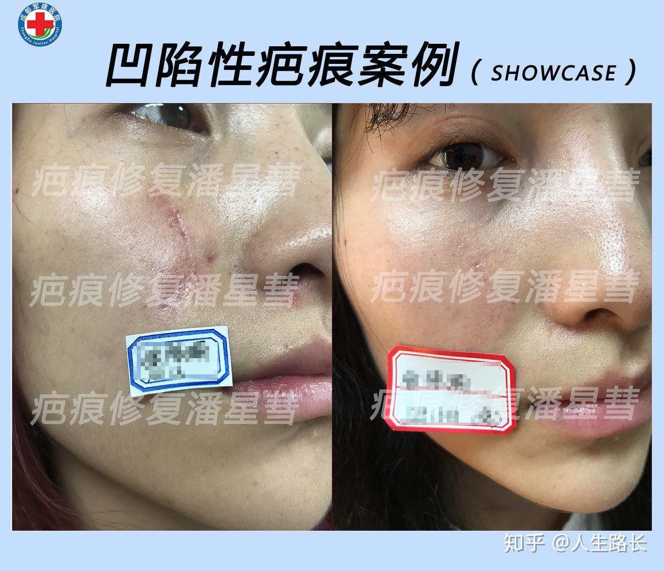 如何淡化脸上的疤痕